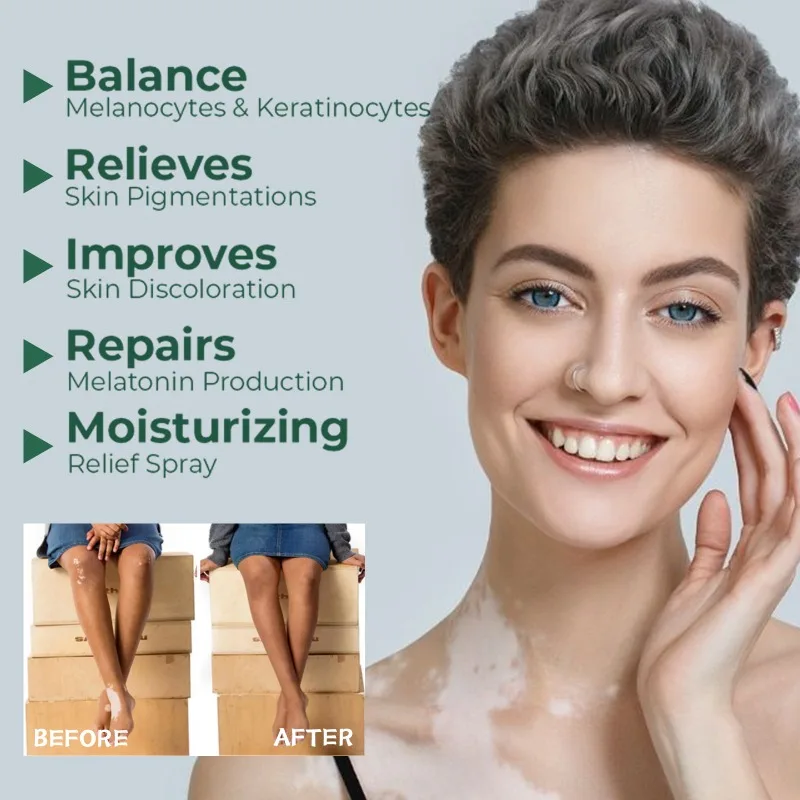 Effectively Remove Vitiligo Ointment Natural Repair Remove Ringworm White Spot Removal Skin Vitiligo Eliminate Skin Care 20g vitiligo ointment