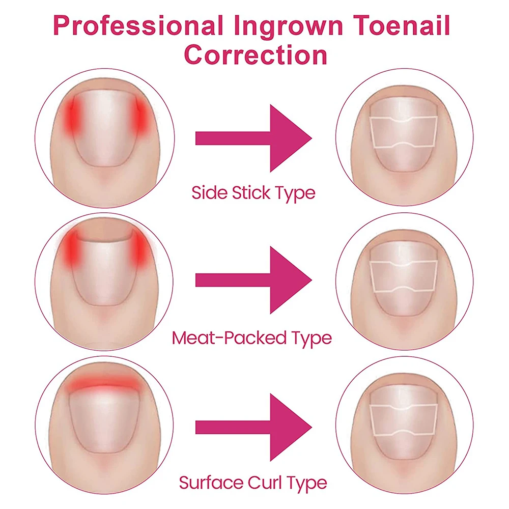 Ingrown Toenail Corrector Patches Nail Correction Care Stickers 50/100pcs,ingrown toenail correction tool,manicure pedicure tool set,foot care tool,foot pedicure tool,foot care patches,toe corrector