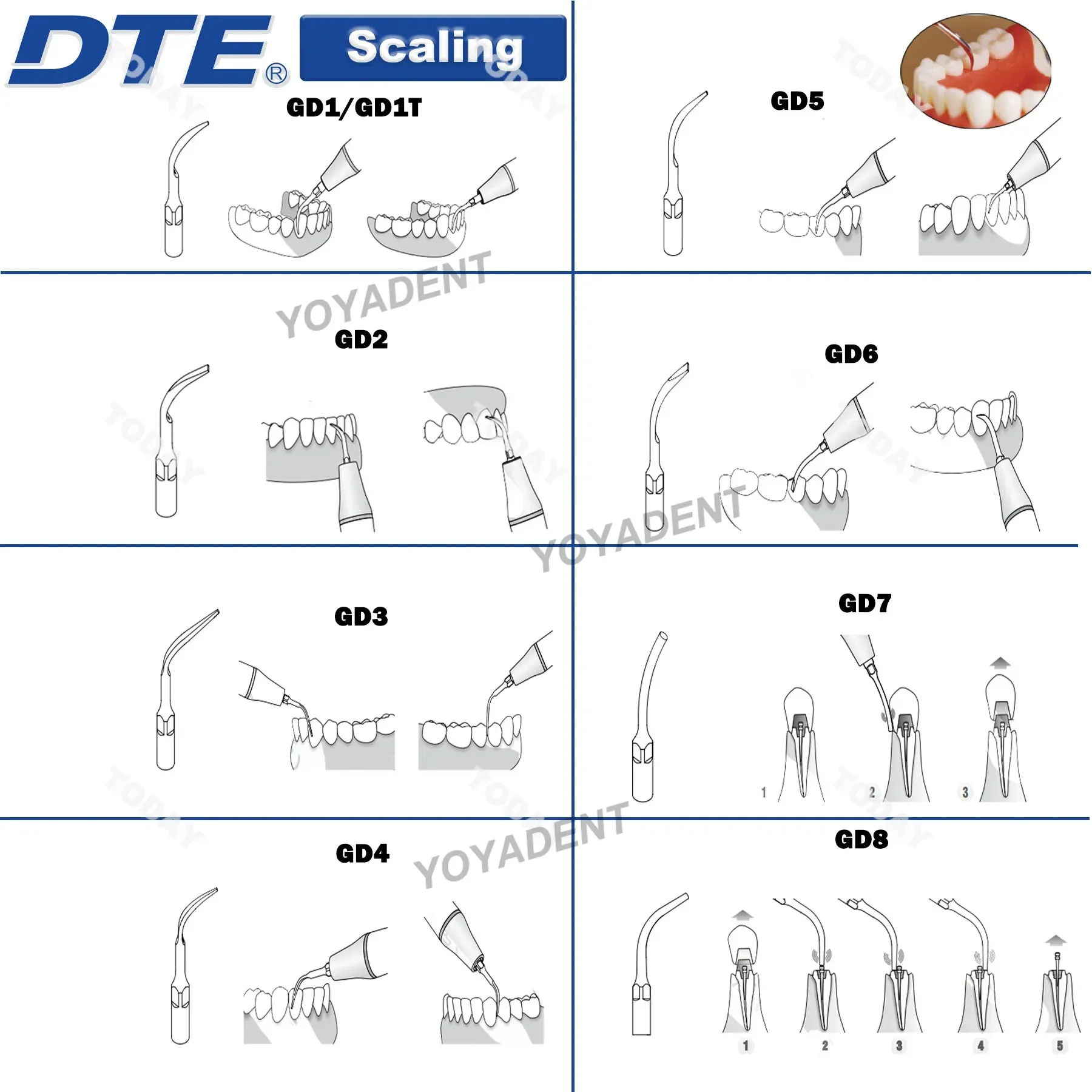Woodpecker DTE Dental Ultrasonic Scaler Tips Periodontics Endodontics Scaling Tips Fit NSK SATELEC Scaler Handpiece Dental Tools 2