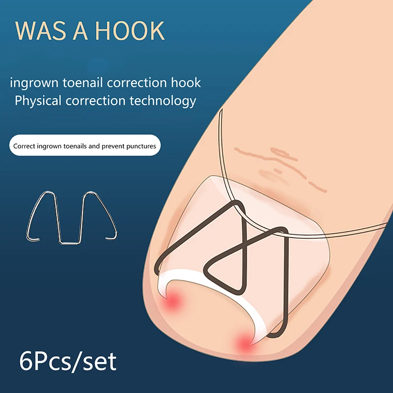 3 Pairs Front Nail Hook/rubber Band Nail Art Ingrown Toe Nail Correction Toenail Nail Ingrown Clip Orthosis Paronychia Pedicure