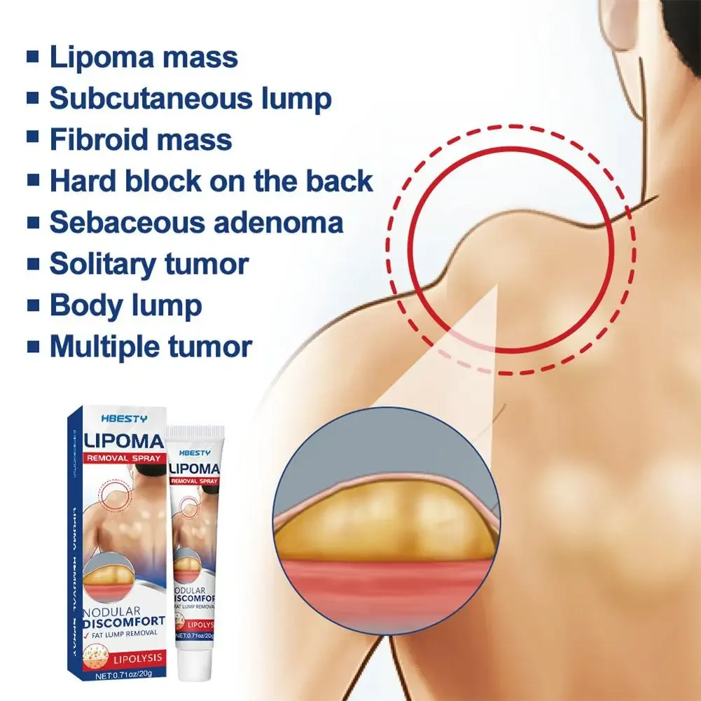 Lipoma Removal Cream Effective Antitumor Remove Fat Lump Ointment Herbal Extracts Nodular Skin Cyst Swelling Painless Treatment pain relief cream,skin care ointment,knee pain relief cream,hemorrhoids treatment cream,antibacterial anti fungal cream,sex delay cream