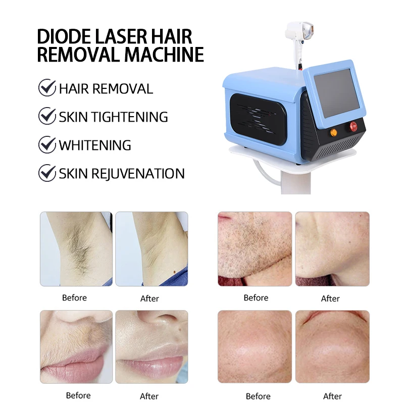 

Professional Single Handle Diode Laser Hair Removal Machine 3 Wavelengths 755nm 1064nm 808nm Permanent Painless Hair Removal Vey