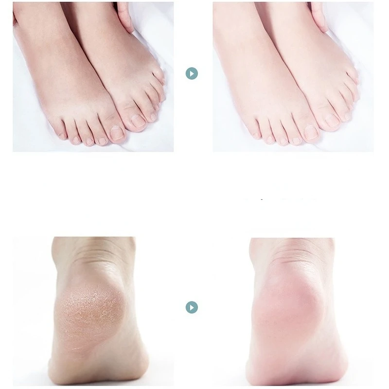 Exfoliating Feet Care Remove Dead Skin Cuticles Heel Pedicure - China  Pedicure and Exfoliating Foot Care Pedicure price