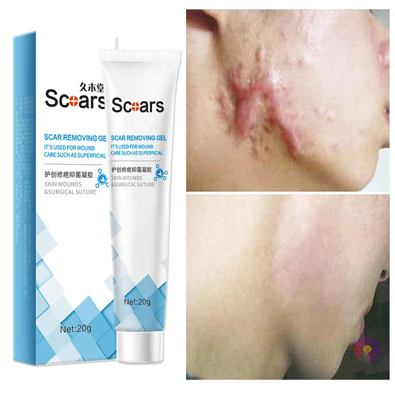 

iBeaLee Herbal Acne Scar Removal Cream Face Body Burn Surgical Scars Treatment Scar Remove Serum