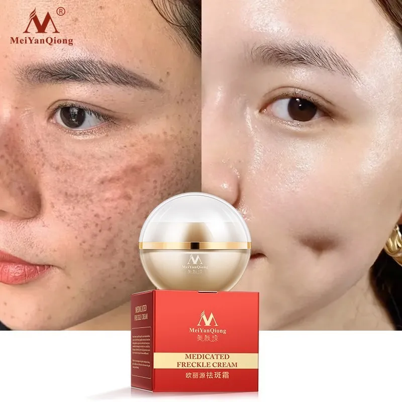 Whitening Freckle Cream fade melanin Remove Dark Spots improve facial pigmentation Brighten Skin Anti-Aging Facial Skin Care