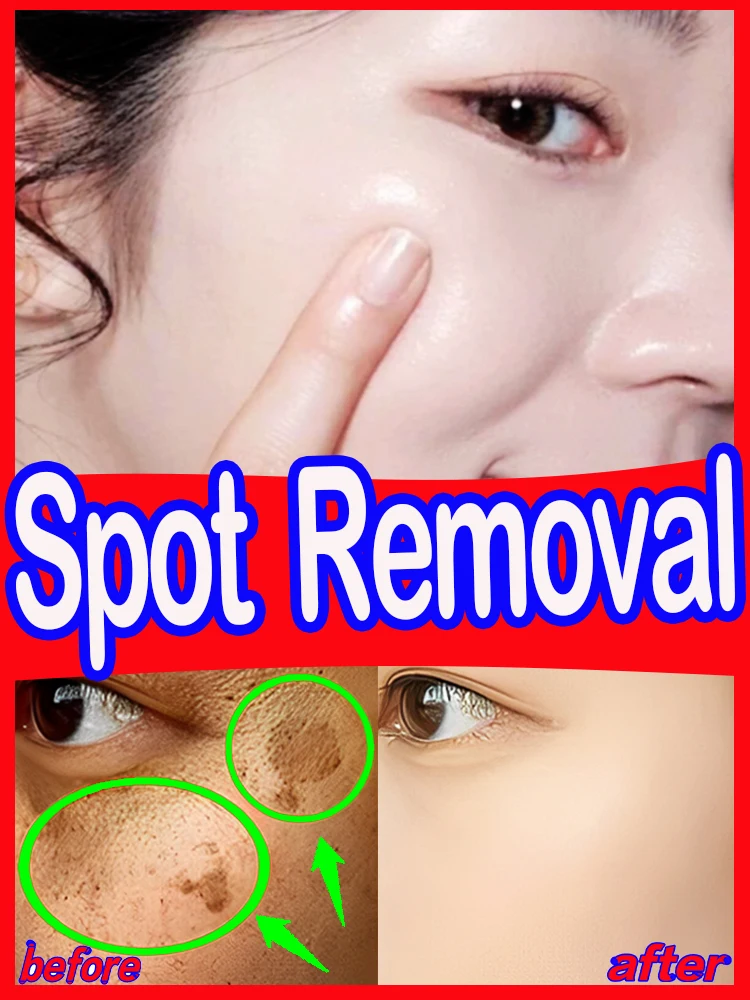 

Freckle Cream Blemish Face Spot Dark Melasma