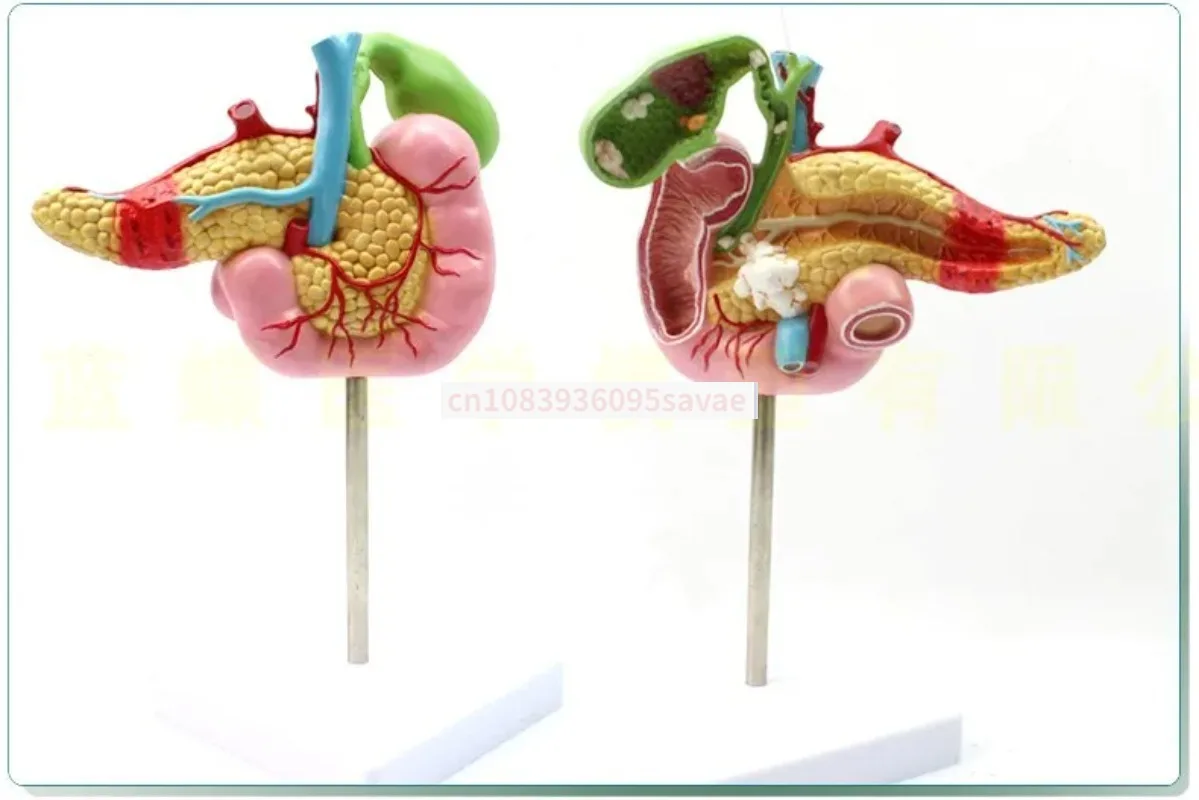

Pancreas duodenum and gallbladder pathological model gallstone surgery digestive system, hepatobiliary model