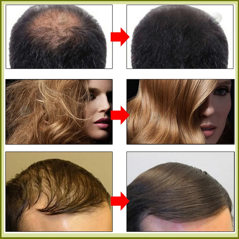 Fast Hair Growth Oil Anti Hair Loss Serum Africa Crazy Traction Alopecia Treatment Scalp Break Strengthener Care Products