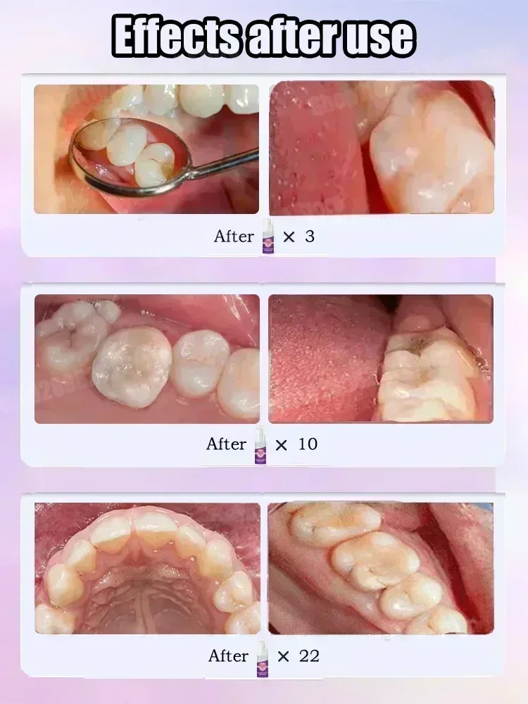 Tooth decay repair all tooth decay cavities protect teeth Colour Correcting