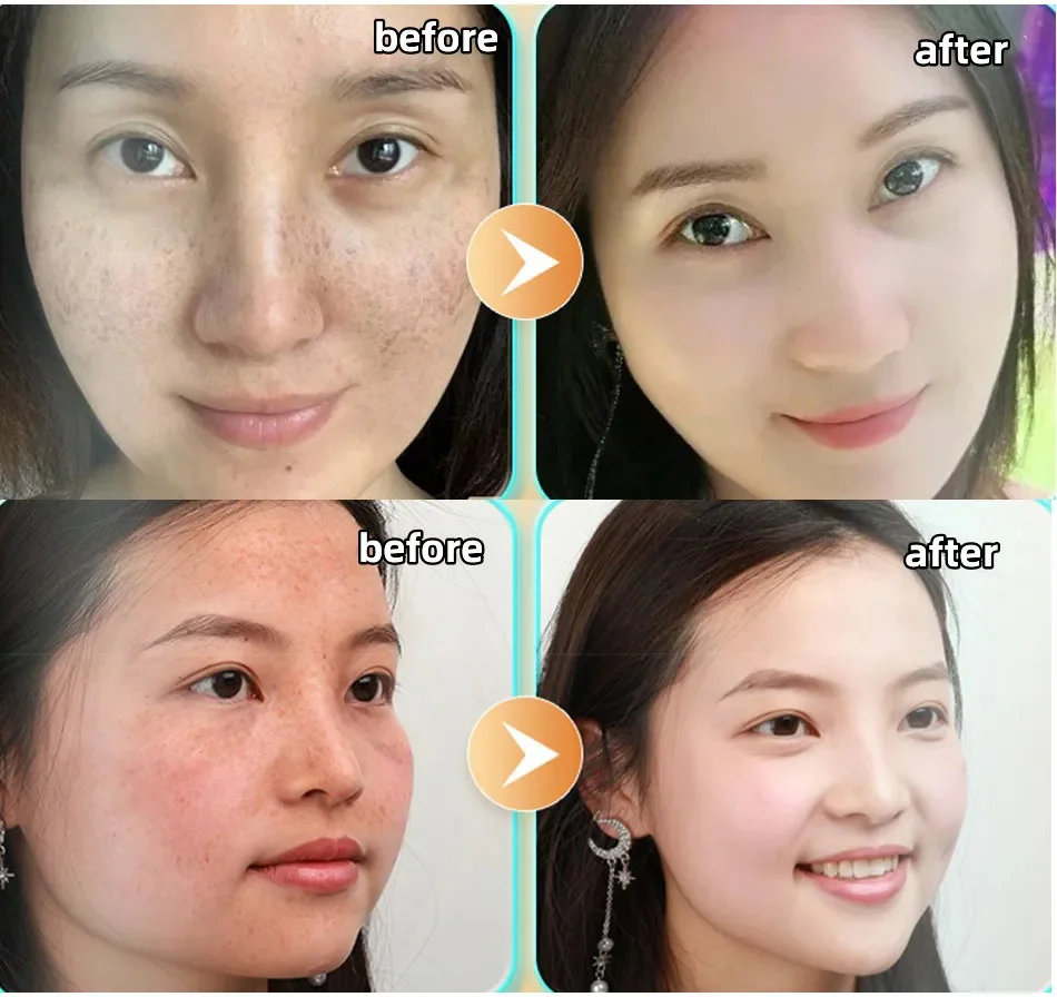 Glutathione Whitening Freckle Face Cream Remove Dark Spots Lighten Melasma Melanin Fade Acne Scars Anti-Aging_voghion.com