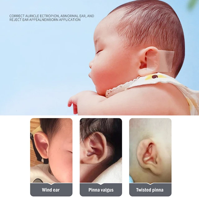 Parche Corrector de oreja para bebé, cinta adhesiva de aurícula