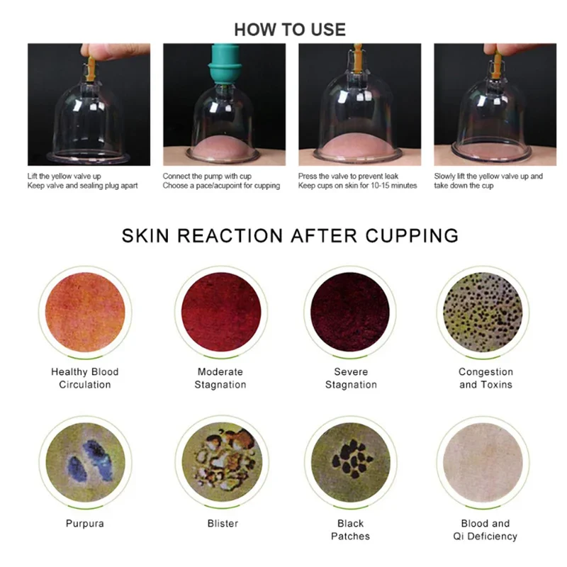 vacuum cupping method step one