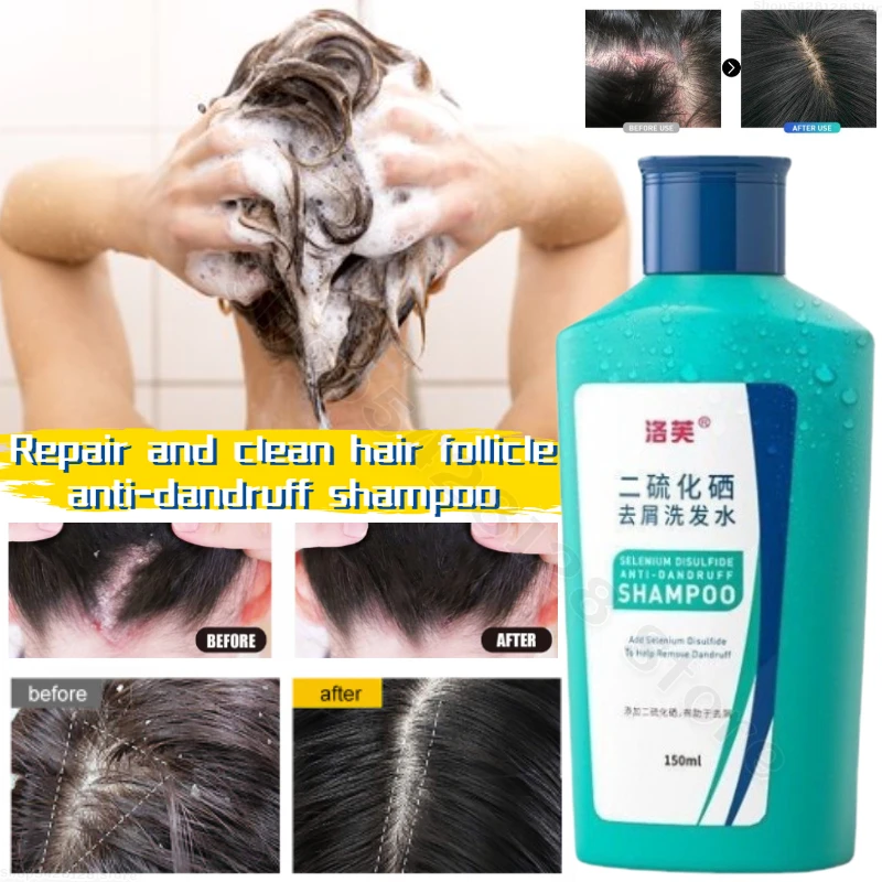 

Improve Greasy Hair Anti-dandruff Shampoo Repair and Nourish Hair Follicles Cleanse Shampoo Refresh and Fluff Your Hair Roots