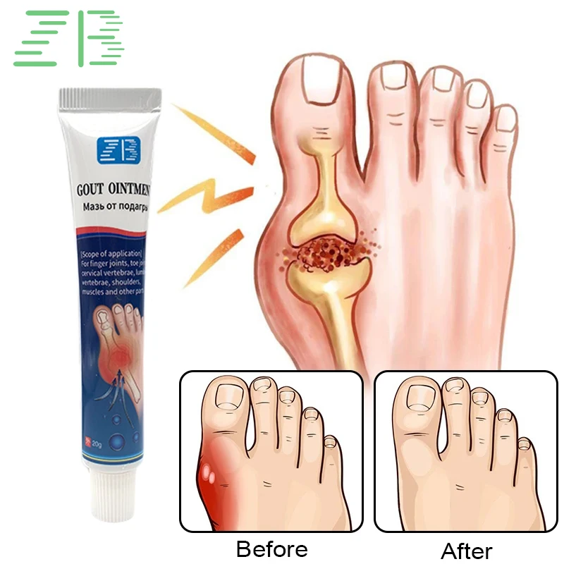 ZB 20g Foot Gout Treatment Cream Thumb Corrector Finger Hallux Ointment Toe Bunion Pain Relieve Medical Plaster Health Care