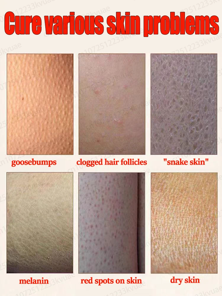 Body lotion solves strawberry legs and clears acne