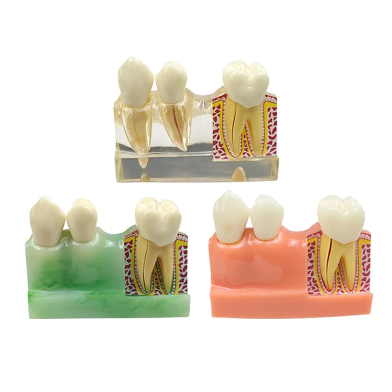 

Caries Disassembling Model Dental Teeth Model Dentist Student Study Learning Dental Materials 1pcs