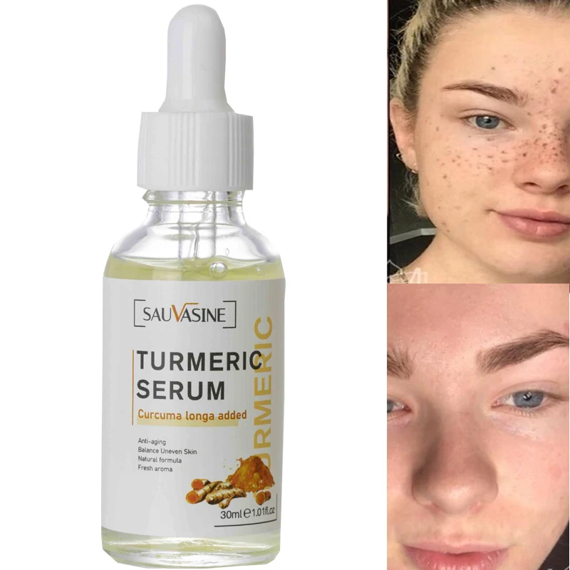 30ml Turmeric Face Serum Whitening Dark Spot Remover Acne Scar Bright