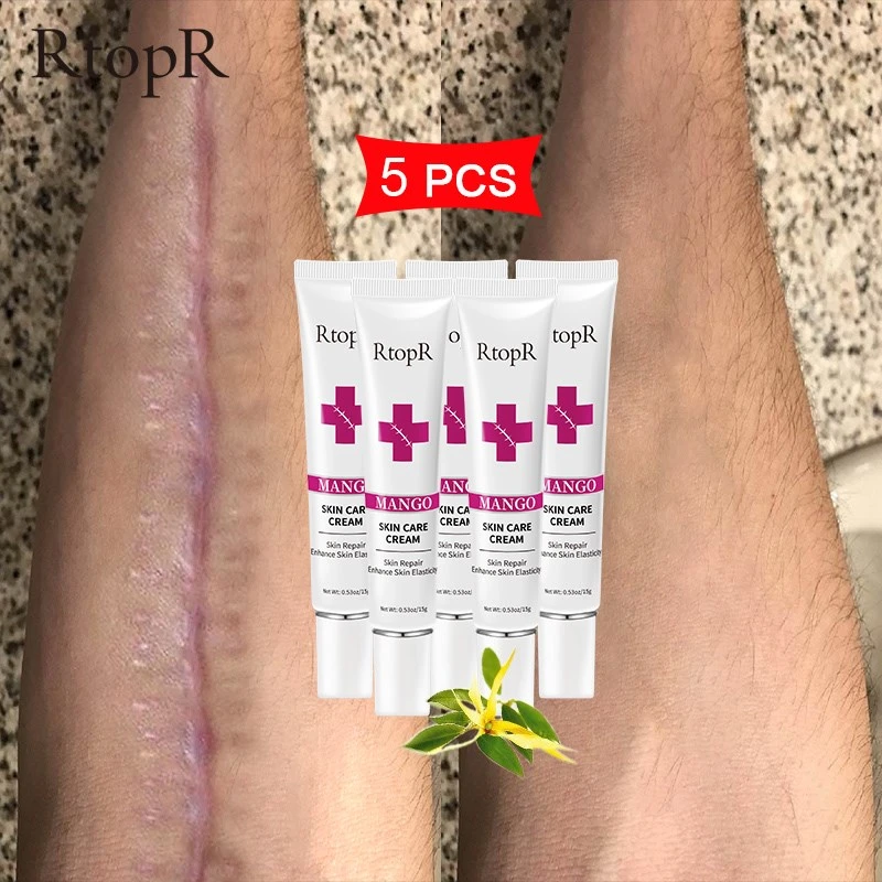 Rtopr Mango Scar Removal Cream Acne Sunburn Burn Mild And Non