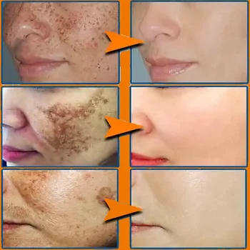 Effective Whitening Freckles Face Cream Remove Melasma Dark Spots Fade Melanin Acne Scars Anti-aging Brighten Repair Skin Care - Thumbnail 2
