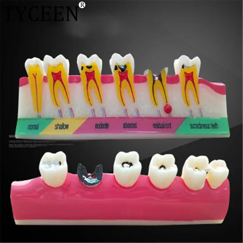 

Dental caries classify model Tooth Model Demonstration Teach Study Dental teeth caries Evolution decayed tooth Analysis Model