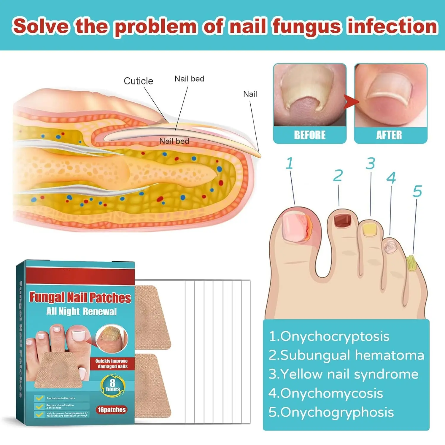 16PCS Foot Nail Repair Patch Grey Fungal Nail Thicken Soft Paronychia Infection Hand Correction Sticker Ingrown Toenail