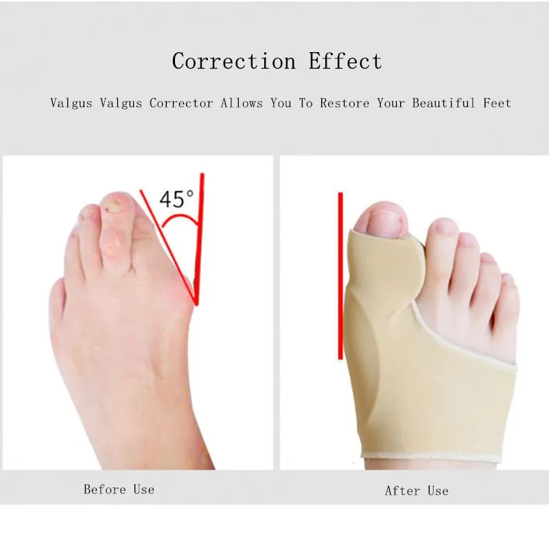 Epitact Bunion Corrector Reviews corona.dothome.co.kr