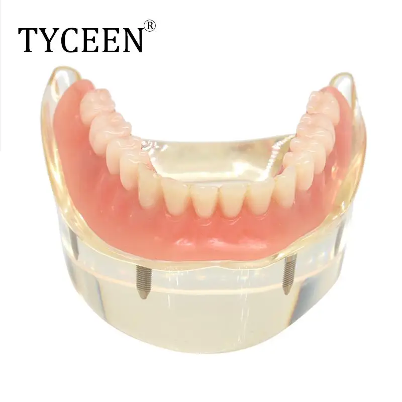 

Dental Overdenture Teeth Model Removable Mandibular Lower Teeth Model with 4pc Implant screws Implant Restoration Model Teaching