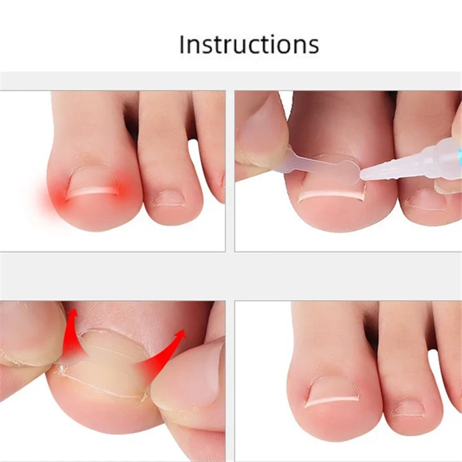 10PCS Ingrown Toe Nail Treatment Ingrown Toenail Correction Tool Elastic Patch Sticker Straightening Clip Brace Pedicure Tools 3