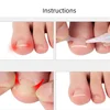 10PCS Ingrown Toe Nail Treatment Ingrown Toenail Correction Tool Elastic Patch Sticker Straightening Clip Brace Pedicure Tools 3