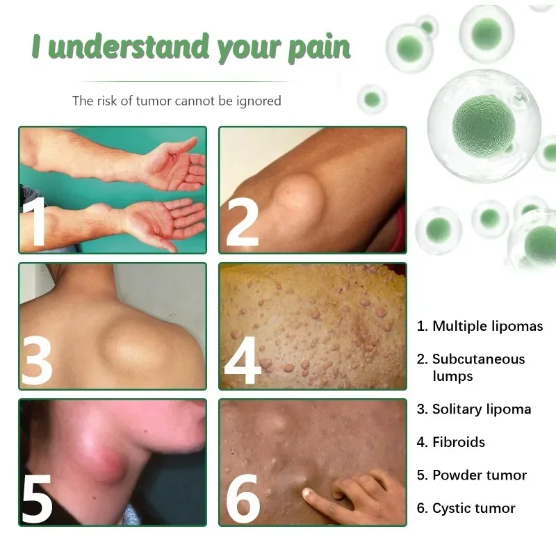 Sdatter 6pcs Treatment Lipoma Removal Patch Skin Swelling Anti-Tumor Cellulite Remove Plaster Lipolysis Fat Lump Body Hard Block