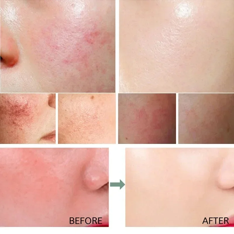 7 Day Repair Redness Serum Sooth Itching Sensitive Skin Improve Rosacea Shrink Pore Smooth Nourish Facial Skin Korean Cosmetics 2