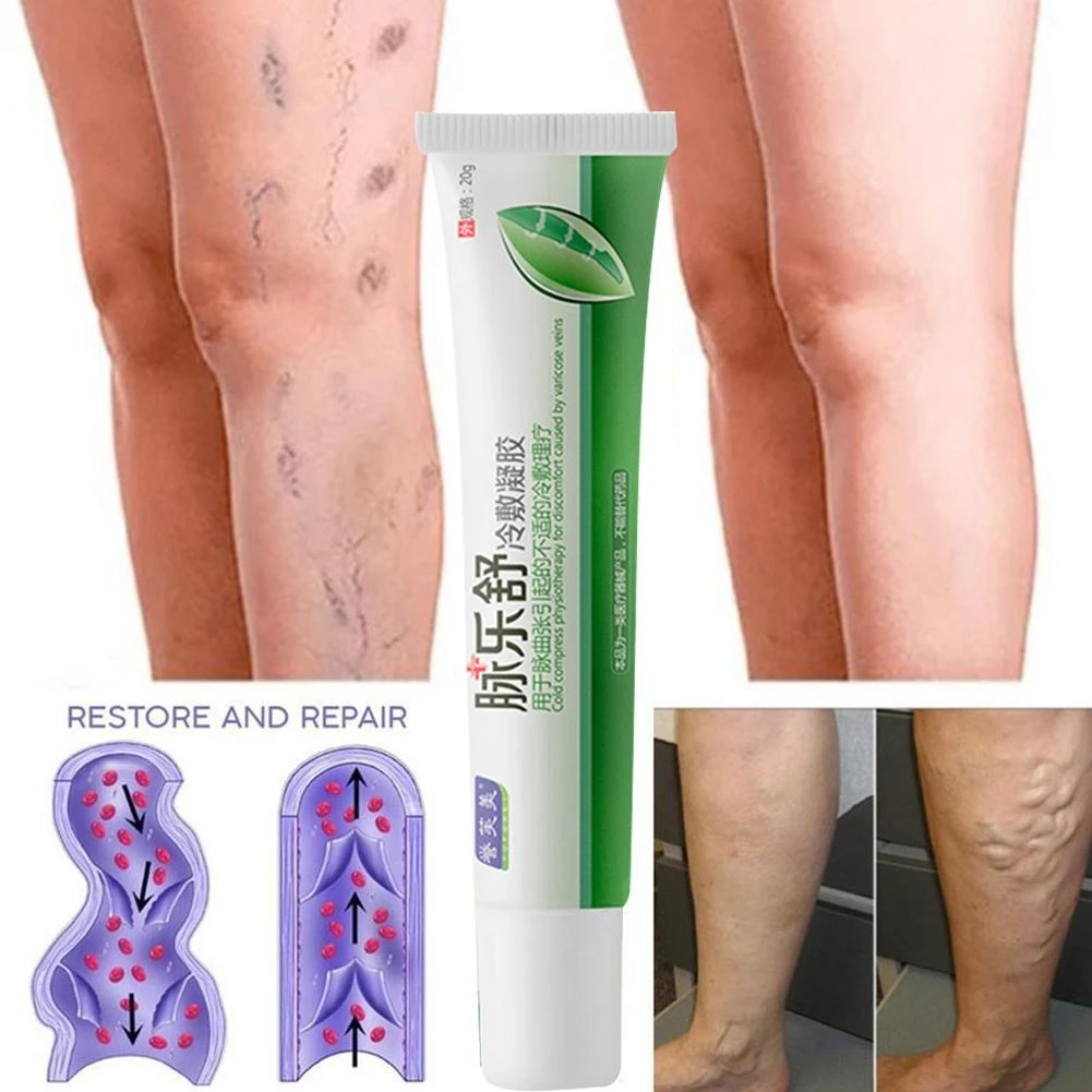 1pc 20g Varicose Vein Cold Compress Gel Phlebitis Vasculitis Swelling Relief Leg Pain Treatment