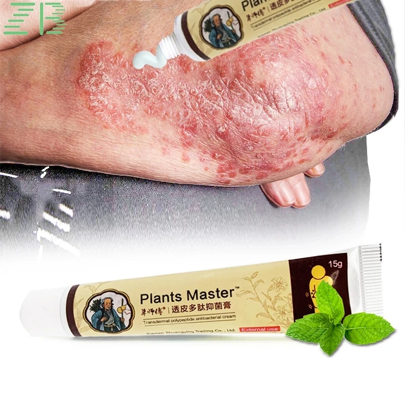 

ZB 2023 Herbal Psoriasis Cream Dermatitis Eczematoid Eczema Ointment Treatment Rash Relief Itch Medical Cream Skin Care Cream