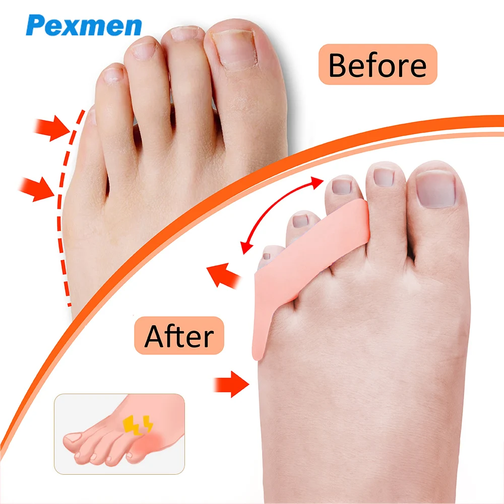 Pinky Toe Bunion