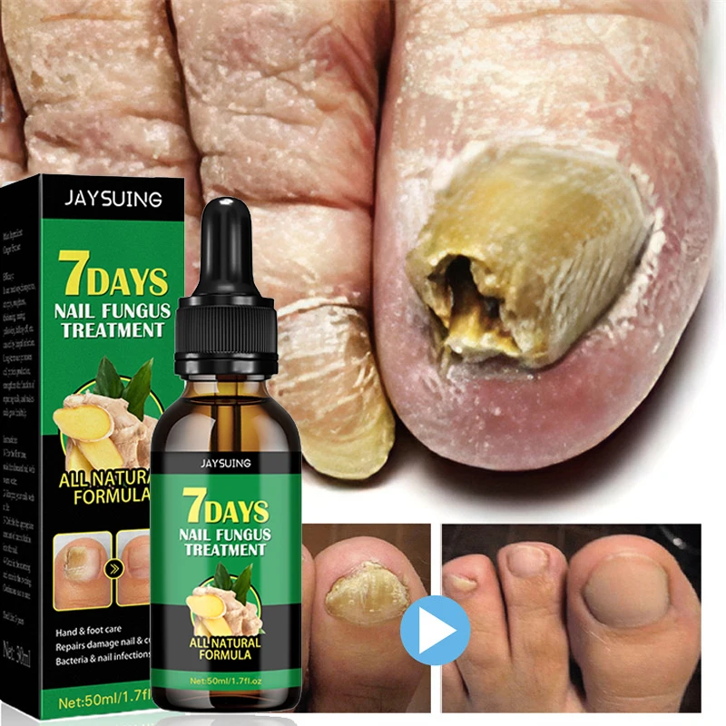 Nail Fungal Treatment Essential Oil Foot Toe Nail Fungus Removal Serum 7 Days Repair Onychomycosi Anti Infection Care Products