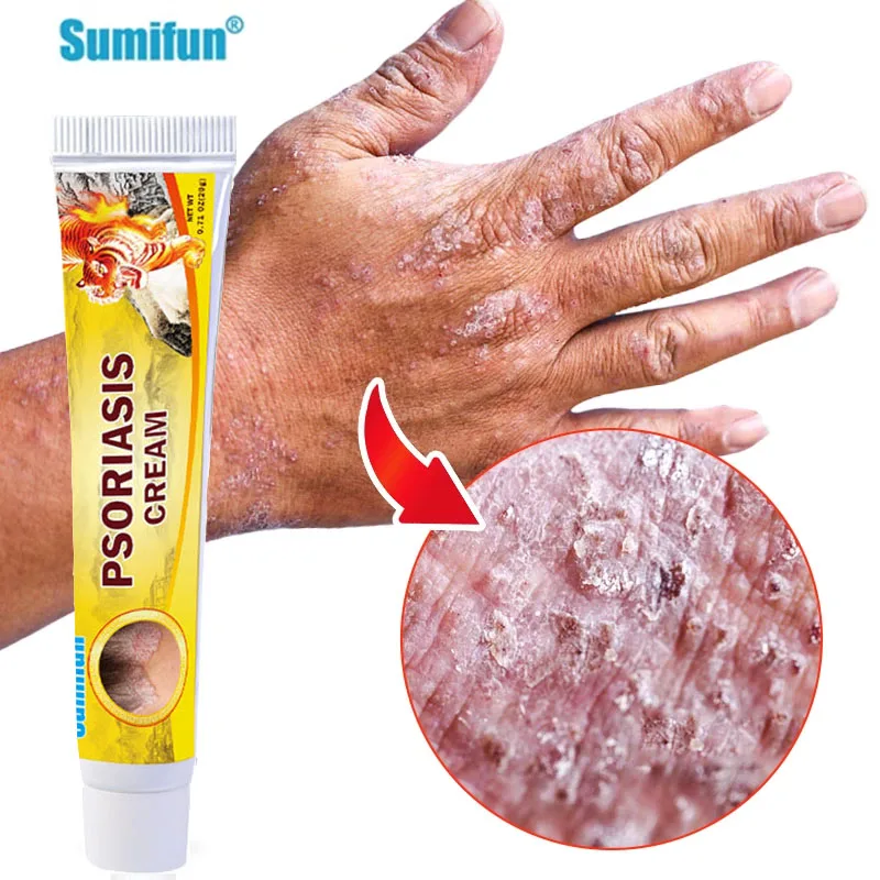 Psoriasi Del Cuoio Capelluto - Metti La Psoriasi Fuorigioco - Foto 7