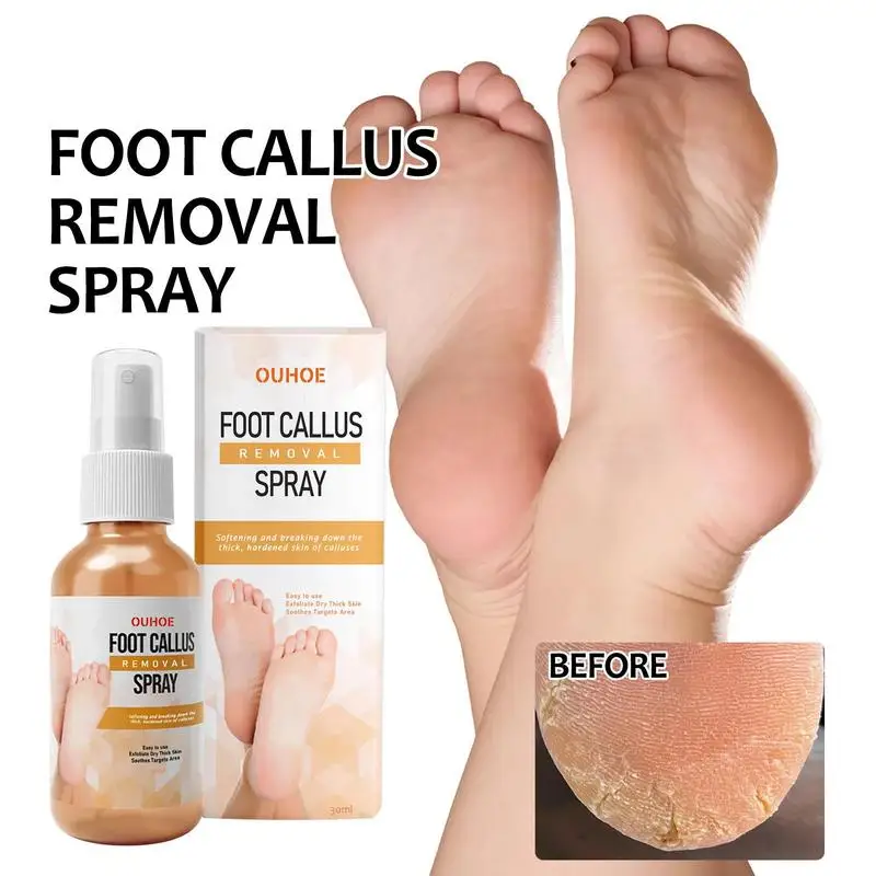 Foot Callus Removal Spray 1.01 Oz Dry Feet Skin Remover Foot Care Callus  Softener For Exfoliation Hydrating Quickly Nourish Feet - AliExpress