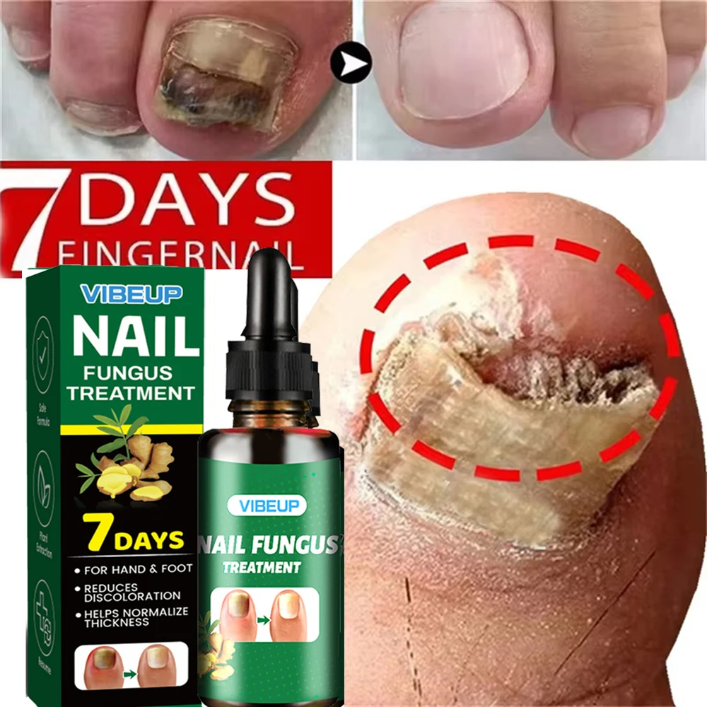 Fungal Nail Treatment Serum 7 Days Foot Nail Fungus Removal Repair Gel Anti Infection Paronychia Onychomycosis Foot Nails Care
