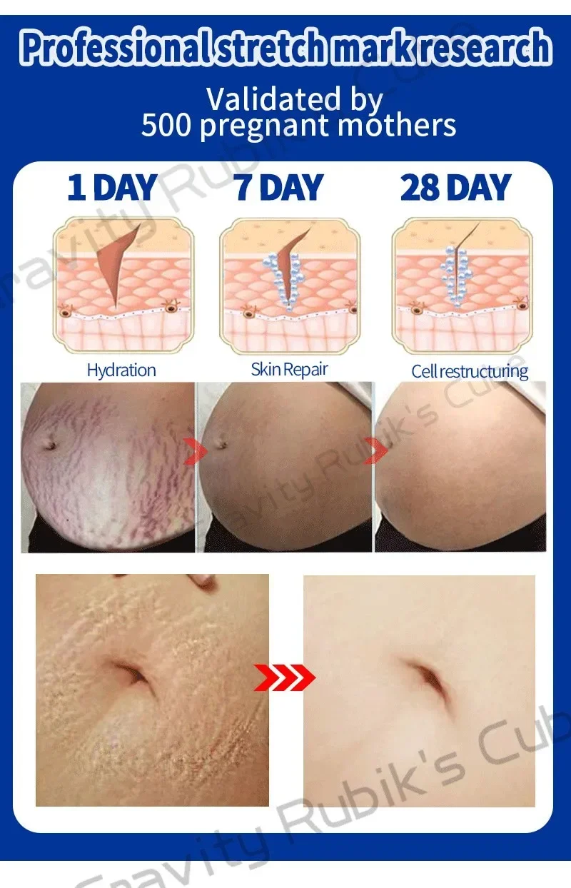 Description Picture 4 of itemStretch Mark Permanent Remover cream Removal Cream White Stretch Mark Remover Stretch Mark Remover