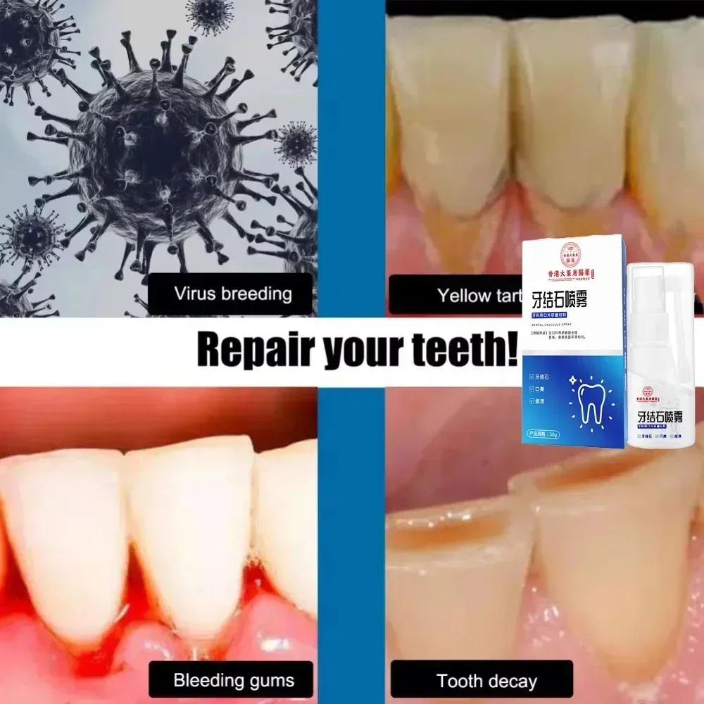 Dissolvant de calcul dentaire, blanchiment des dents, vaporisateur, livres de dentifrice, hygi&egrave;ne buccale, &eacute;limination
