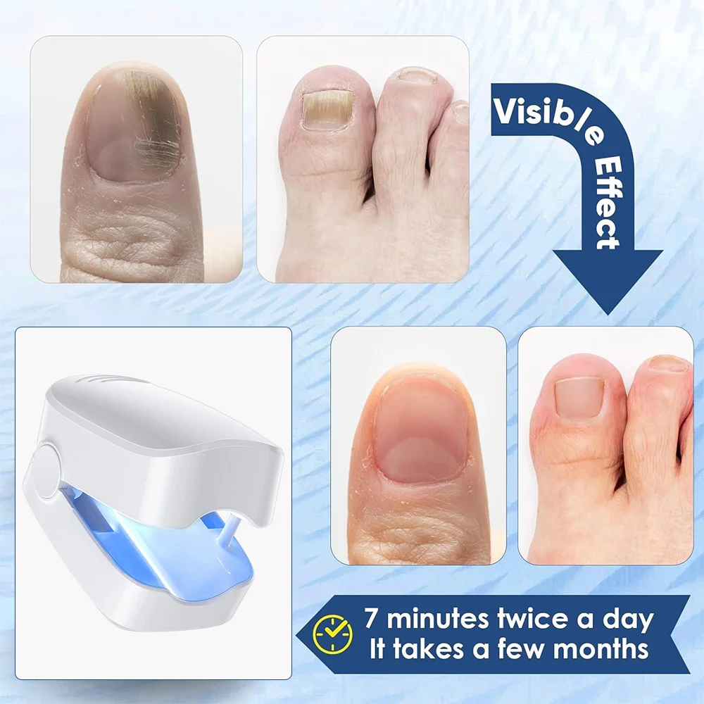 Nail Fungus Laser Assist Tool UV Professional Nail Fungus Cleaning Laser Device Phototherapy Lamp Type-C Charging