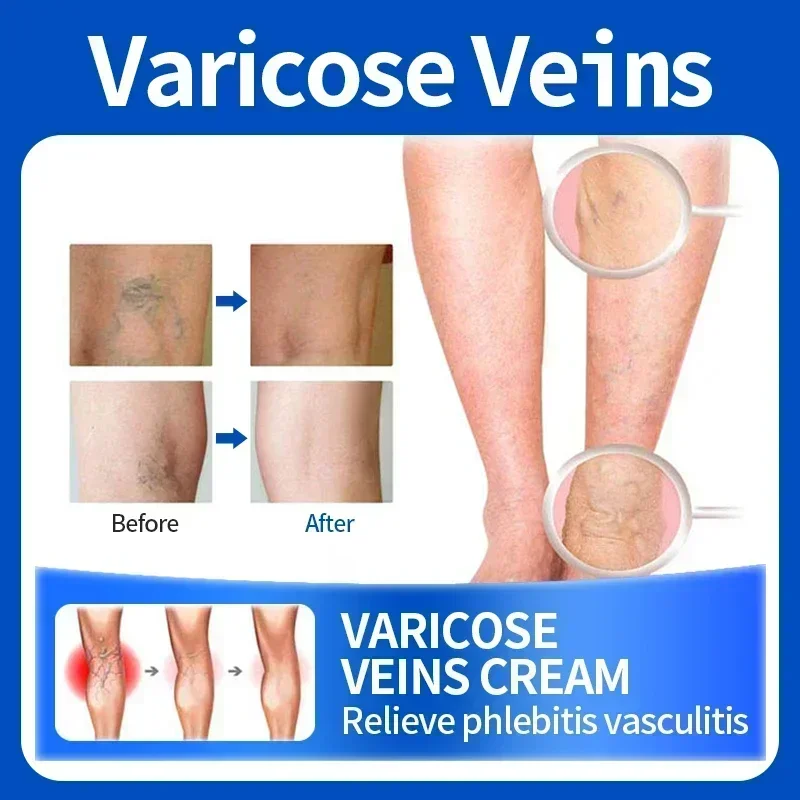 Varicose Vein Repair Cream Relieves Leg Bulge Pain Treatment Vasculitis Phlebitis