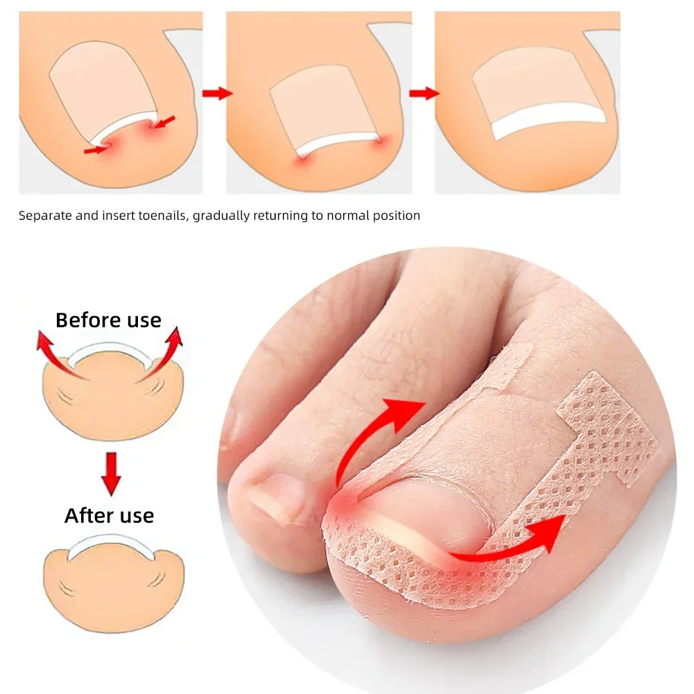 Nail Correction Stickers Ingrown Toenail Corrector Patches Treatment Recover Corrector Pedicure Care Tool 4Pcs/Sheet