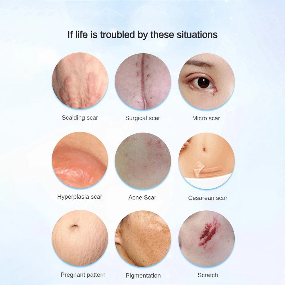 Skin Scar Removal Cream For Burns Surgery Plastic Surgery Hyperplasia Acne Marks Stretch Marks Pigment Skin Care skin cream