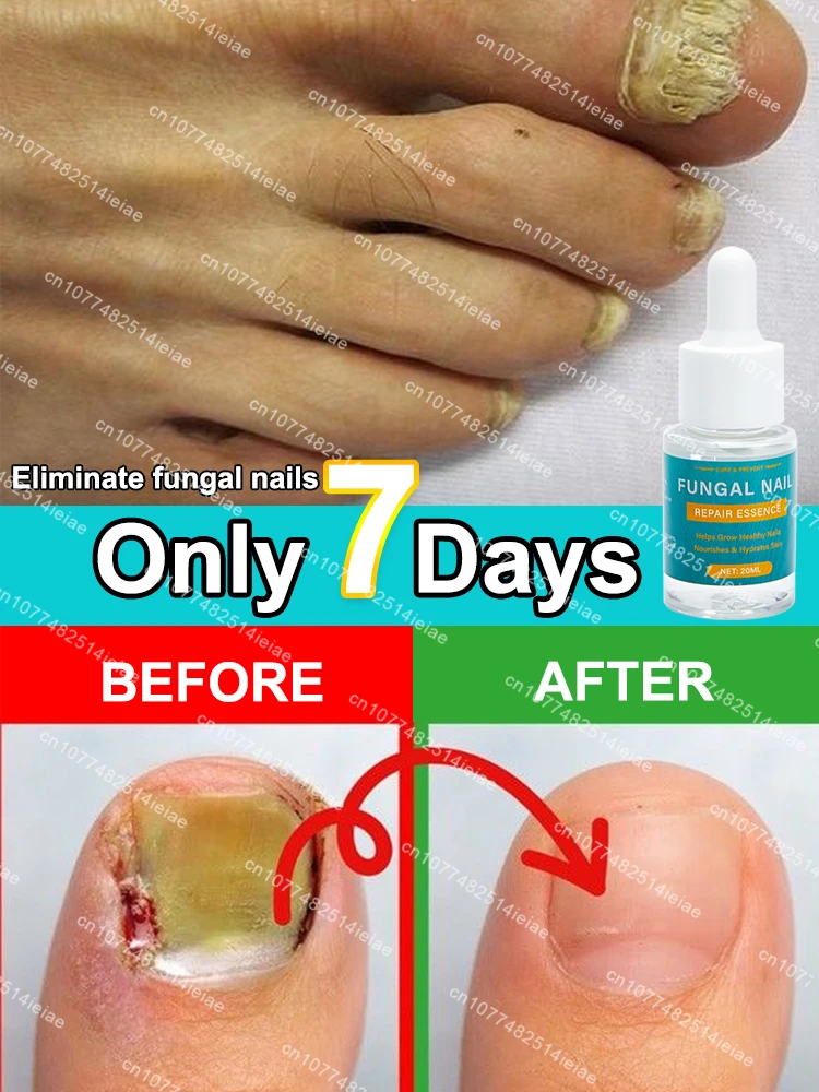 Nail fungus treatment essential oil repair onychomycosis in 7 days