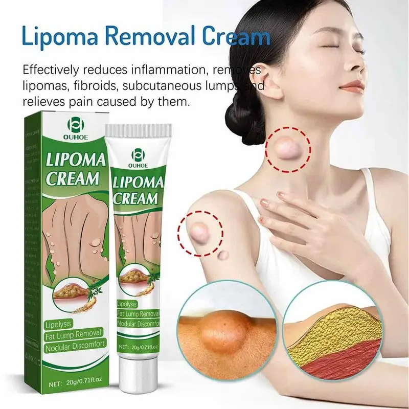 

1PC Delipidation Lipoma Cream Organic Herbal Lipoma Remove Fat Lumps subcutaneous mass Lotion for Arms Legs Belly Body Care