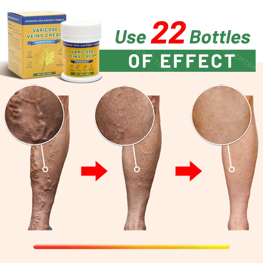 Varicose vein removal cream Foot skin care treatment Varicose veins relieve skin itching and pain symptoms Unblock blood circula Varicose Vein Ointment