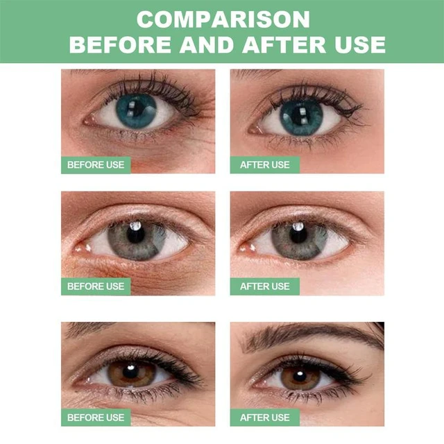 Details 147+ reduce bags under eyes esthdonghoadian