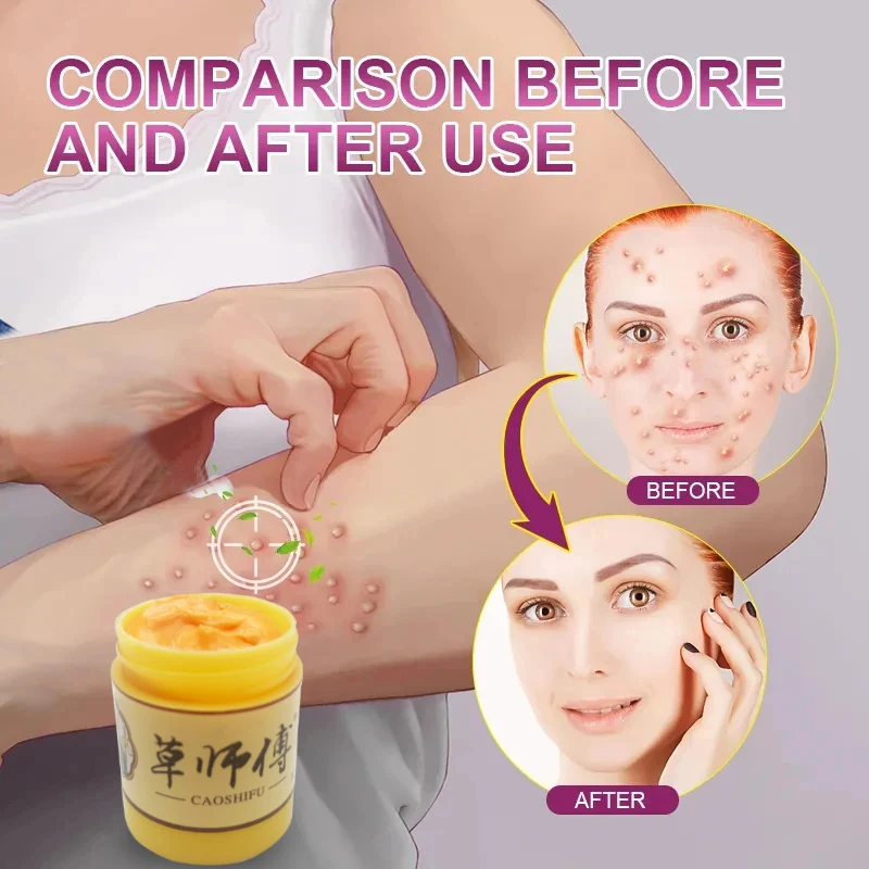 10g ZB Psoriasis cream treating eczema dermatitis antibacterial ointment urticaria natural plant skin itching repair pain relief cream