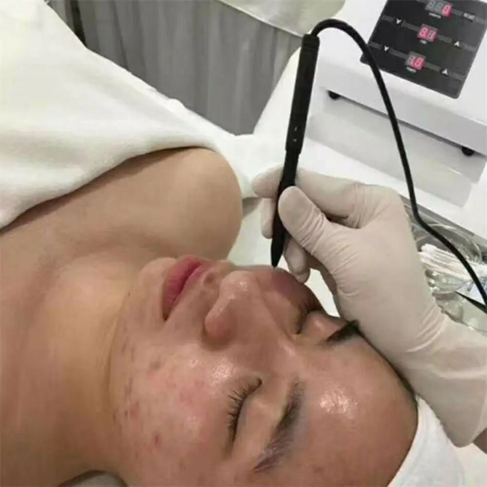 Portable Korea Technology Acacia Acne Treatment Device Professional Acne Removal Machine Shrink Pores Remove Blackhead Skin Care 6